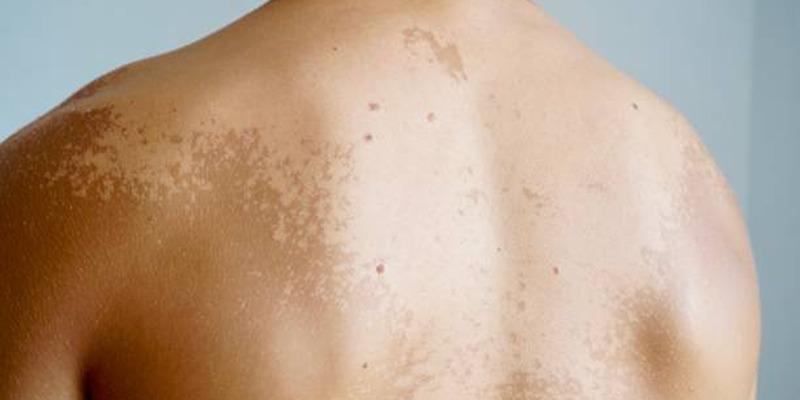What Causes Mottled Skin and How to Treat Blotchy Skin